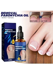 6PCs German Toenailcare Removal Paronychia Oil, Ingrown Toenail Nail Repair, German Toenailplus Oil Nail Renewal Liquid